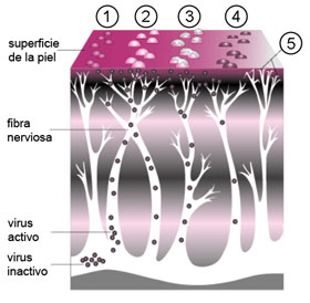 herpes como tratarlo